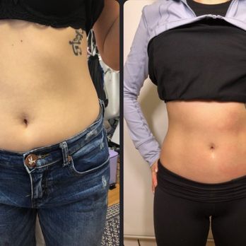 Body Beauty Team - Before and after of my emsculpt service! - Skin Care Near Me - Allen, Texas