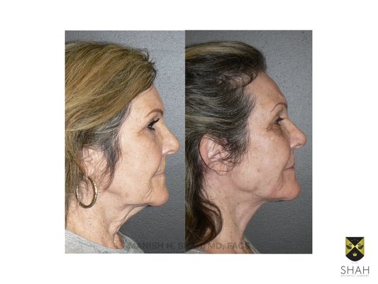 Shah Aesthetic Surgery - Rhinoplasty and Facelift Specialist by null
