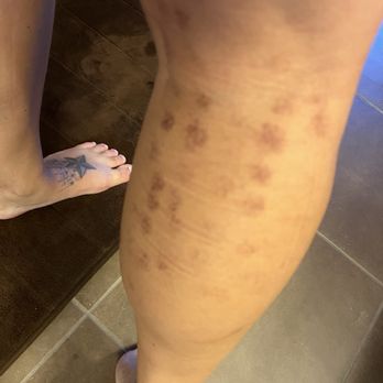LaserAway - Scabbed laser burns - Medical Spas Near Me - Roseville, California