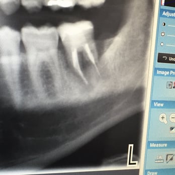 Granite Hills Dental Team - General Dentistry Near Me - El Cajon, California Granite Hills Dental Team - General Dentistry Near Me - El Cajon, California
