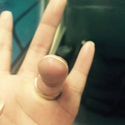 Medworks - The stitches are gone..... My finger looks great! It feels a little weird, but it should correct itself