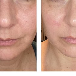 Beautifully Balanced Skincare - Before and after one Peptide Firming Facial