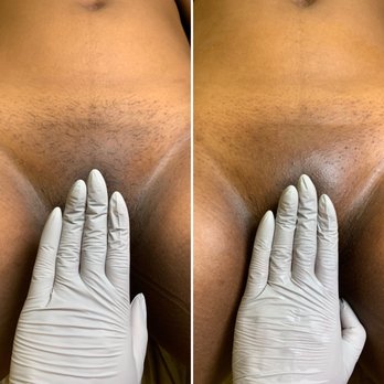 Mixed Esthetics - Brazilian Wax Before & After - Waxing Near Me - San Diego, California