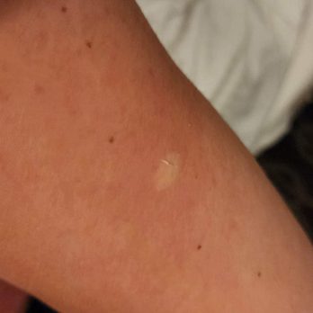 Argosy Casino & Hotel - Bed Bug Bite and Rash - Casinos Near Me - Riverside, Missouri Argosy Casino & Hotel - Bed Bug Bite and Rash - Casinos Near Me - Riverside, Missouri