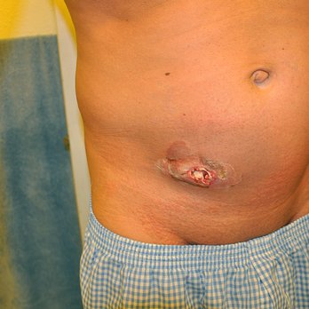 Australian Tan - This is that infection that i mentioned in my negative review against this dirty, and unprofessional place, that nearly caused my death. - Spray Tanning Near Me - Sunnyvale, California Australian Tan - This is that infection that i mentioned in my negative review against this dirty, and unprofessional place, that nearly caused my death. - Spray Tanning Near Me - Sunnyvale, California