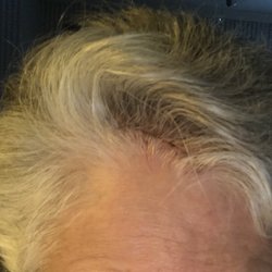 Bruce Byrne, MD - Staples came out Friday.  I expect over time it will be totally unnoticeable.