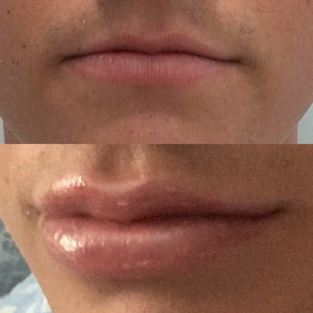 Aydin Center For Plastic Surgery - Before and after one syringe of juvederm ultra - Cosmetic Surgeons Near Me - Paramus, New Jersey Aydin Center For Plastic Surgery - Before and after one syringe of juvederm ultra - Cosmetic Surgeons Near Me - Paramus, New Jersey