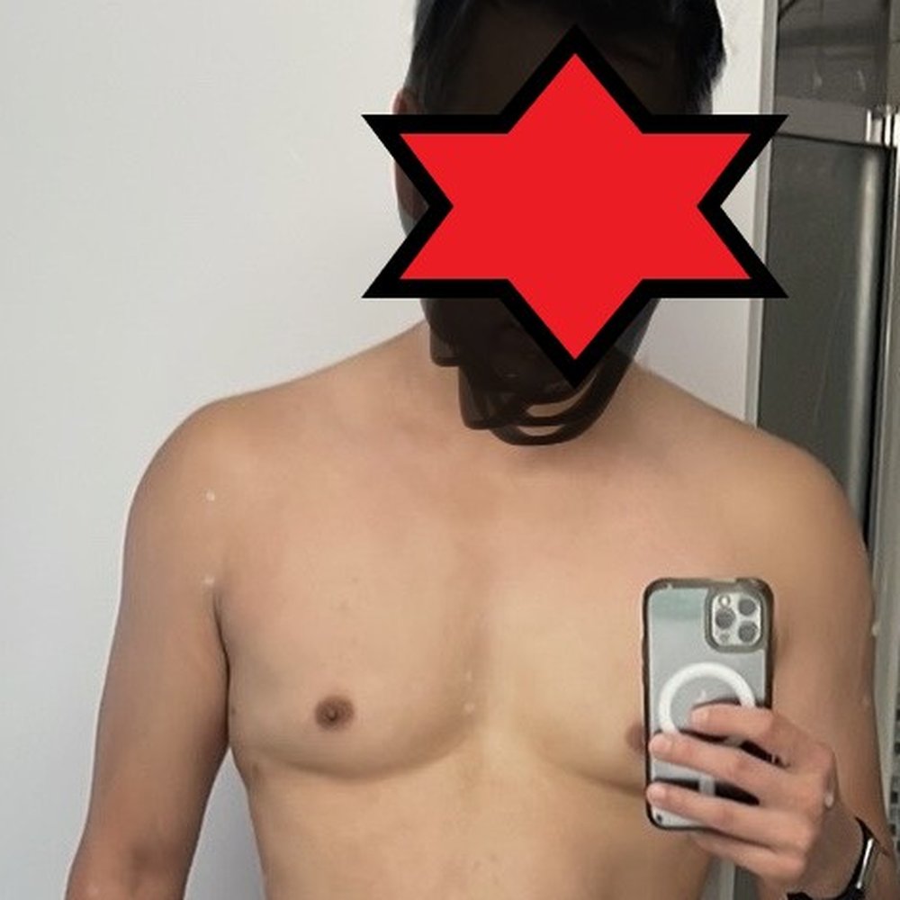 LipoMD - After - Plastic Surgeons Near Me - Montreal, Quebec LipoMD - After - Plastic Surgeons Near Me - Montreal, Quebec