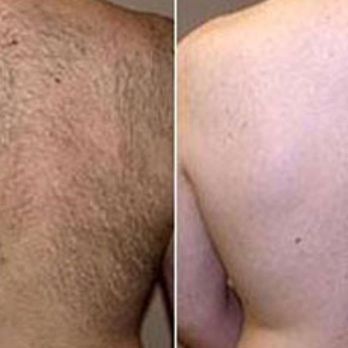 Lendrum Sugaring - Before and After - Waxing Near Me - Edmonton, Alberta Lendrum Sugaring - Before and After - Waxing Near Me - Edmonton, Alberta