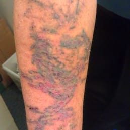 After 1st treatment healed