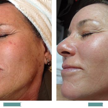 Desert Alchemy Skin - BioRepeel in action! - Skin Care Near Me - Scottsdale, Arizona Desert Alchemy Skin - BioRepeel in action! - Skin Care Near Me - Scottsdale, Arizona