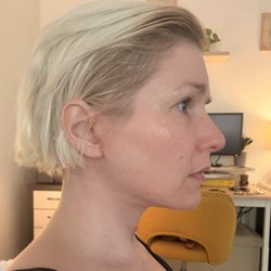 Howard Gross, MD - 6 weeks post op