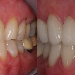 Rose Cosmetic & Family Dentistry - Cosmetic makeover with the use of porcelain veneers.