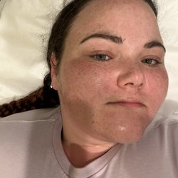 Lavender Med Spa - Micro needling post