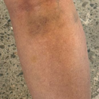 Oracle Park - More bruises - Stadiums & Arenas Near Me - San Francisco, California