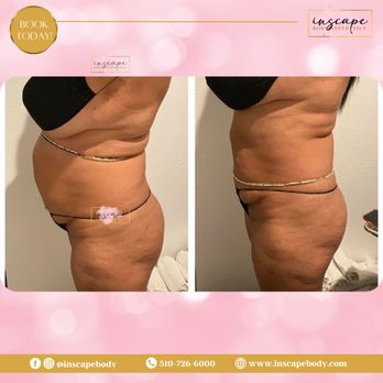 Inscape Body Aesthetics - B/A - Body Contouring Near Me - Benicia, California Inscape Body Aesthetics - B/A - Body Contouring Near Me - Benicia, California