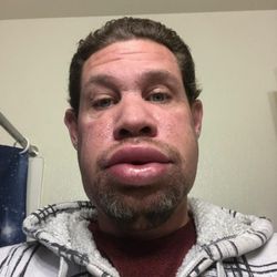Gary Cohen, MD - Allergy & Asthma Prevention & Treatment Center - Hereditary Angioedema is cruel.