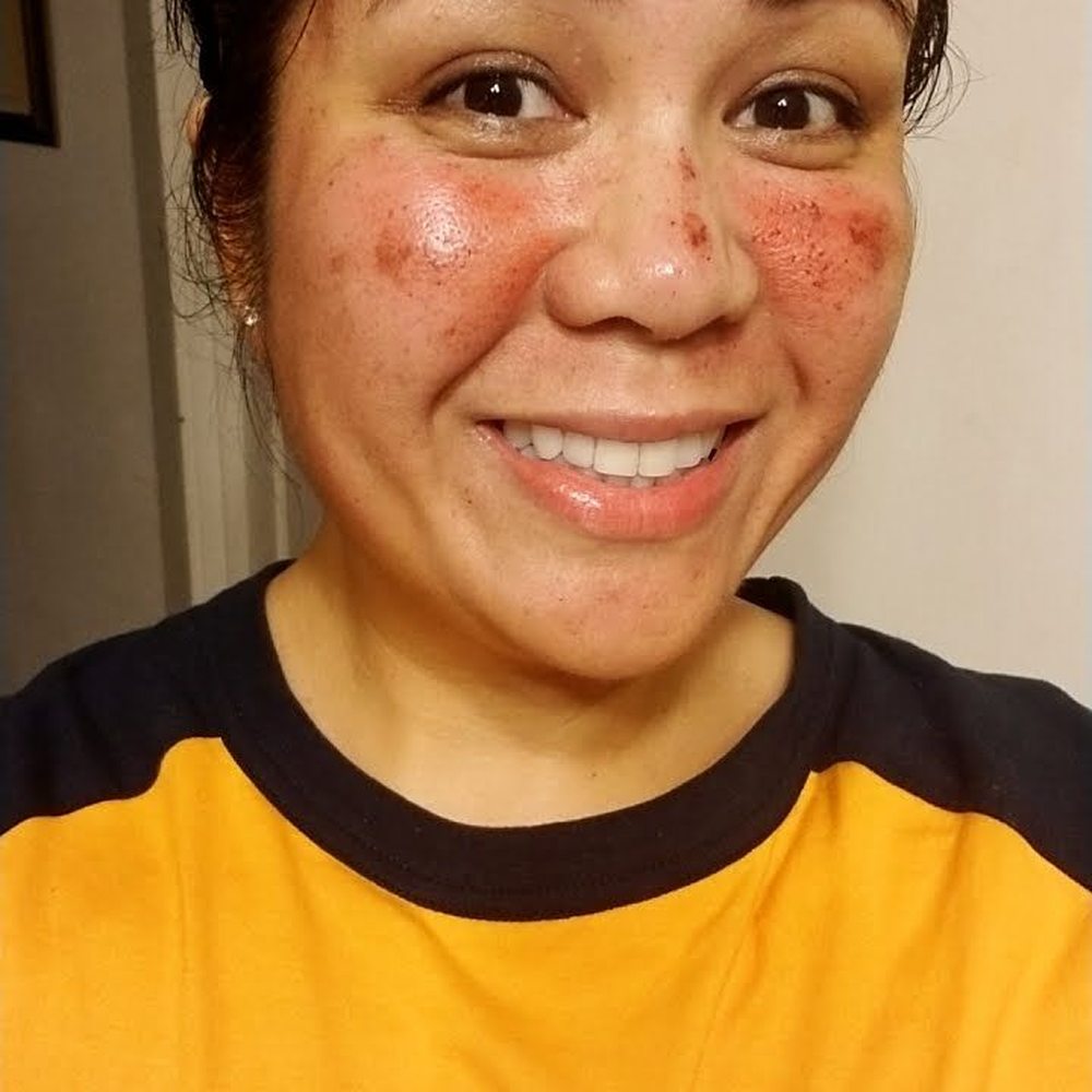 Origin Health Center - Day 2 Looks worse than it really is. I continued to keep it moisturized, and no makeup. - Naturopathic/Holistic Near Me - Oakland, California