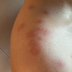 Norwegian Cruise Lines - Bed Bug Bites on my shoulder from NCL Encore