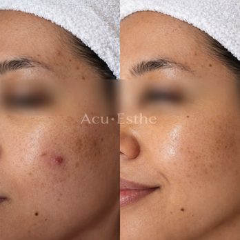 AcuEsthe - Acne Before & After
Results after microneedling treatment, designed to improve acne, texture, and overall skin clarity. - Acne Treatment Near Me - Tenafly, New Jersey AcuEsthe - Acne Before & After
Results after microneedling treatment, designed to improve acne, texture, and overall skin clarity. - Acne Treatment Near Me - Tenafly, New Jersey