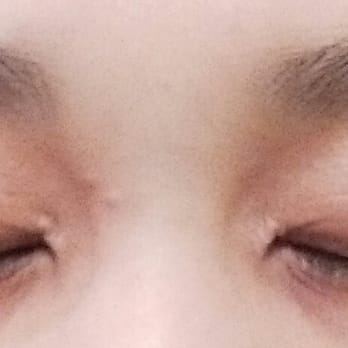 Oasis Organic Beauty Spa - The result of their REALLY BAD eyebrow waxing. They literally ripped the skin off my eyelid! Notice the redness and rawness of my skin! - Day Spas Near Me - Manhasset, New York
