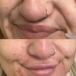 Beyond Harmony Medical Spa & Luxury Aesthetics - Before and after marionette lines