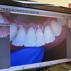 Monika Bhatia, DDS - Post cleaning