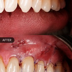 Eso Dental, Allen Hoang, DDS - Have recession? We treat that too!