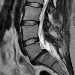 Pain Relief Associates - Completely deteriorated disk with stress fractures from bones rubbing together