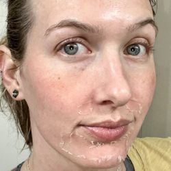 The Skin Bar - Post PCA peel