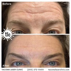 Tacoma Laser Clinic - Botox before and after.