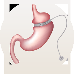 Orlando Center for Metabolic & Obesity Surgery - A GASTIC BAND CAN HELP YOU ACHIEVE REAL WEIGHT LOSS! http://www.saynotoobesity.com/weight-loss-procedures/gastric-band/