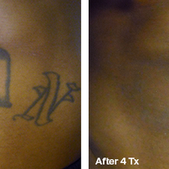 Nu Skyn - Tattoo Removal Near Me - Fort Wayne, Indiana Nu Skyn - Tattoo Removal Near Me - Fort Wayne, Indiana