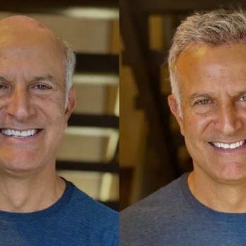Thursday's Hair Solutions - Men's Non-Surgical, Safe Hair Restoration Before & After - Hair Loss Centers Near Me - Calabasas, California Thursday's Hair Solutions - Men's Non-Surgical, Safe Hair Restoration Before & After - Hair Loss Centers Near Me - Calabasas, California