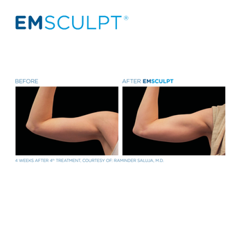 Emsculpt - Emsculpt after 4th treatment - Skin Care Near Me - Beverly Hills, California