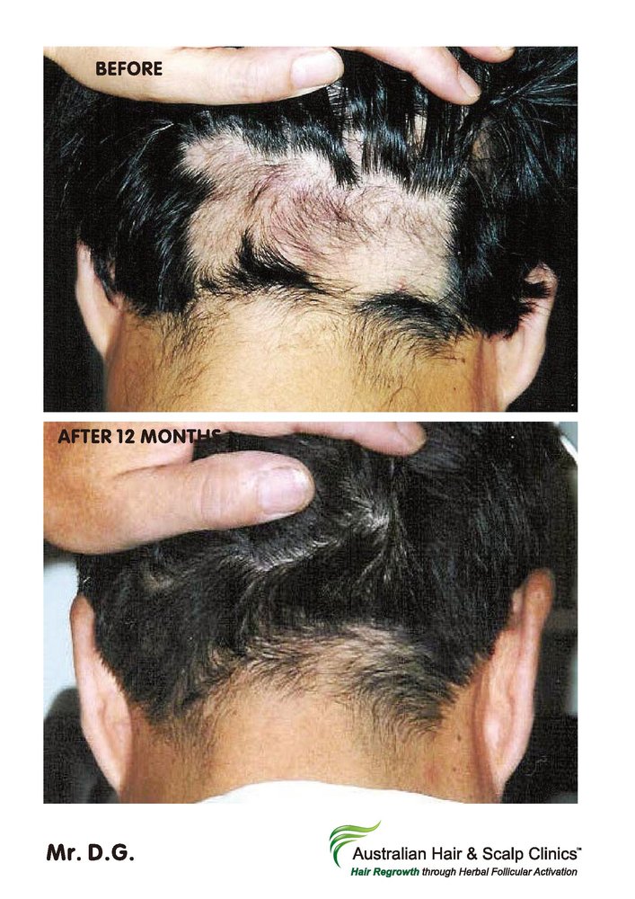 AUSTRALIAN HAIR & SCALP CLINIC Updated September 2024 81 Photos