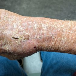Shasta Orthopaedics - This is what Furraro did to my hand and wrist! It wasn't like this before surgery! Now the liar Furraro has made me the bogeyman!
