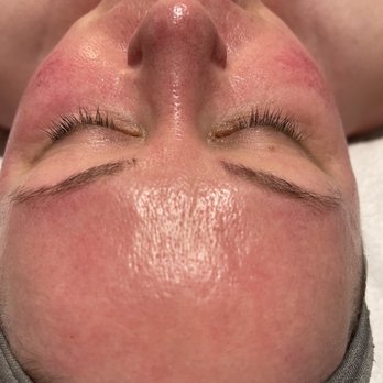 NeuSkin Esthetics - This is the after "glow" of a HydraFacial! It felt amazing and I had the best shoulder/arm massage. - Skin Care Near Me - Hollister, California NeuSkin Esthetics - This is the after "glow" of a HydraFacial! It felt amazing and I had the best shoulder/arm massage. - Skin Care Near Me - Hollister, California