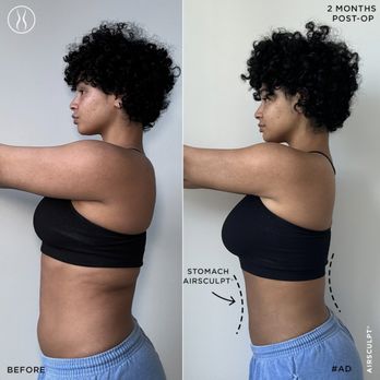 AirSculpt - Orange County - Body Contouring Near Me - Irvine, California AirSculpt - Orange County - Body Contouring Near Me - Irvine, California