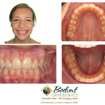 Bedont Orthodontics - 4) AFTER - Orthodontists Near Me - Camas, Washington