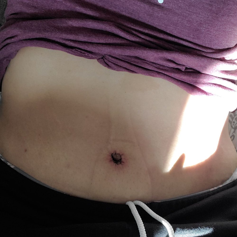 Iconic Plastic Surgery - 3 weeks post op! - Cosmetic Surgeons Near Me - Carlsbad, California Iconic Plastic Surgery - 3 weeks post op! - Cosmetic Surgeons Near Me - Carlsbad, California