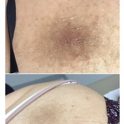 Medical Aesthetics Of Monroe - Before and after 2 sessions of IPL treatment for hyperpigmentation