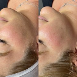 Skin Secure Aesthetics - Dermaplaning Before & After