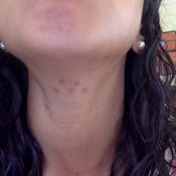Dr Bouyarden Center - burns from laser hair removal - Medical Spas Near Me - Bellaire, Texas Dr Bouyarden Center - burns from laser hair removal - Medical Spas Near Me - Bellaire, Texas