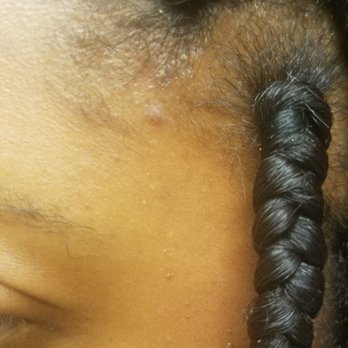 Claudette's Braiding Gallery - Sores from the braids being too tight. These are all over my head and are very painful. It is not dandruff, they are raised and very tender. - Hair Salons Near Me - Takoma Park, Maryland