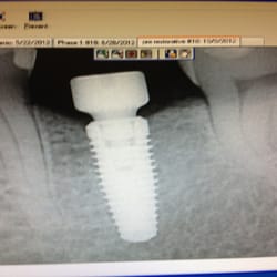 Ballard Oral Surgery  - My titanium implant