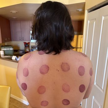K Spa - Cupping after math haha - Massage Near Me - Las Vegas, Nevada K Spa - Cupping after math haha - Massage Near Me - Las Vegas, Nevada