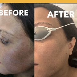 Laser Skin Wellness Center - This before & after 2 treatments of laser genesis & 1 chemical peel & plant base products for home care.