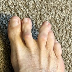 This was my toes before surgery by Dr Michael Miller.