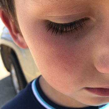 Journey Church - Bruise on his cheek. It was just beginning to bruise here. - Churches Near Me - Pineville, Louisiana